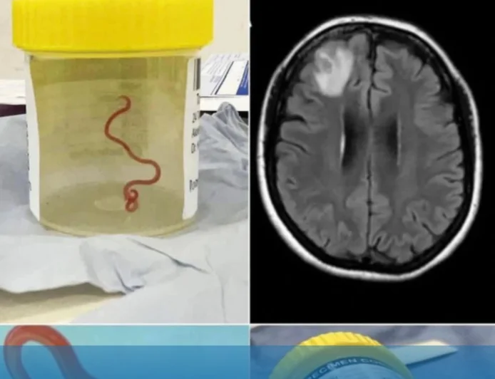 Nadir Görülen Parazit Operasyonla Beyninden Çıkarıldı: Avustralyalı Kadının Yaşayan Sekiz Santimetrelik Kurtla Mücadelesi Tıp Dünyasında Yankı Uyandırdı