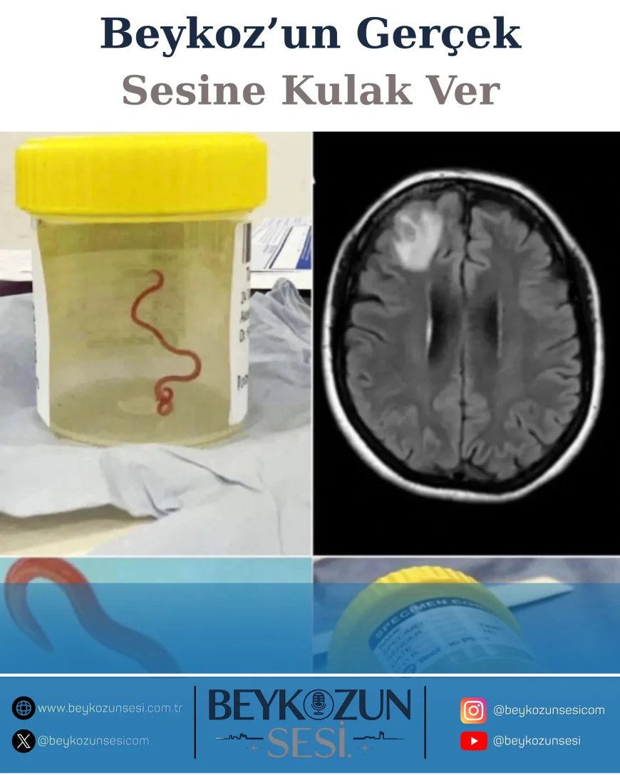 Nadir Görülen Parazit Operasyonla Beyninden Çıkarıldı: Avustralyalı Kadının Yaşayan Sekiz Santimetrelik Kurtla Mücadelesi Tıp Dünyasında Yankı Uyandırdı